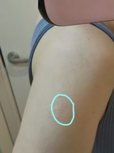 写真：ワクチン3回目ブースター「モデルナ」腕の画像。少し赤み